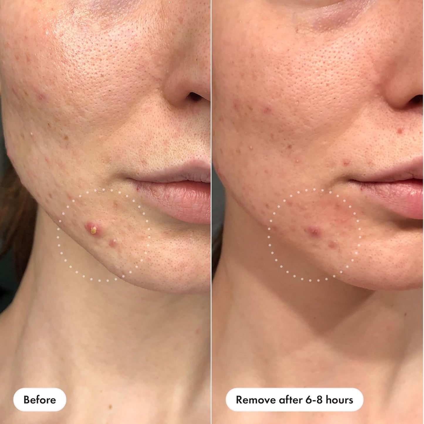 Hero Cosmetics Mighty Patch Invisible+ Acne Patch | 39 Patches