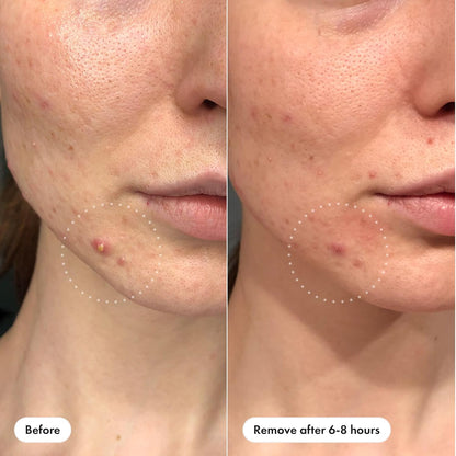 Hero Cosmetics Mighty Patch Invisible+ Acne Patch | 39 Patches